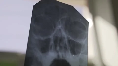 Close up of the X-ray image in the hands of a doctor Stock-Footage 149127596
