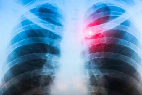 Close up, X-ray scan of  Dislocation of the acromial end of the clavicle. Stock Photos