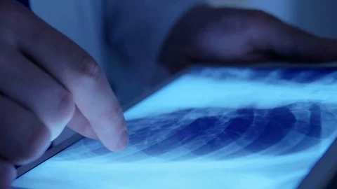 Close-up of x-ray on the tablet Stock Footage 75135428