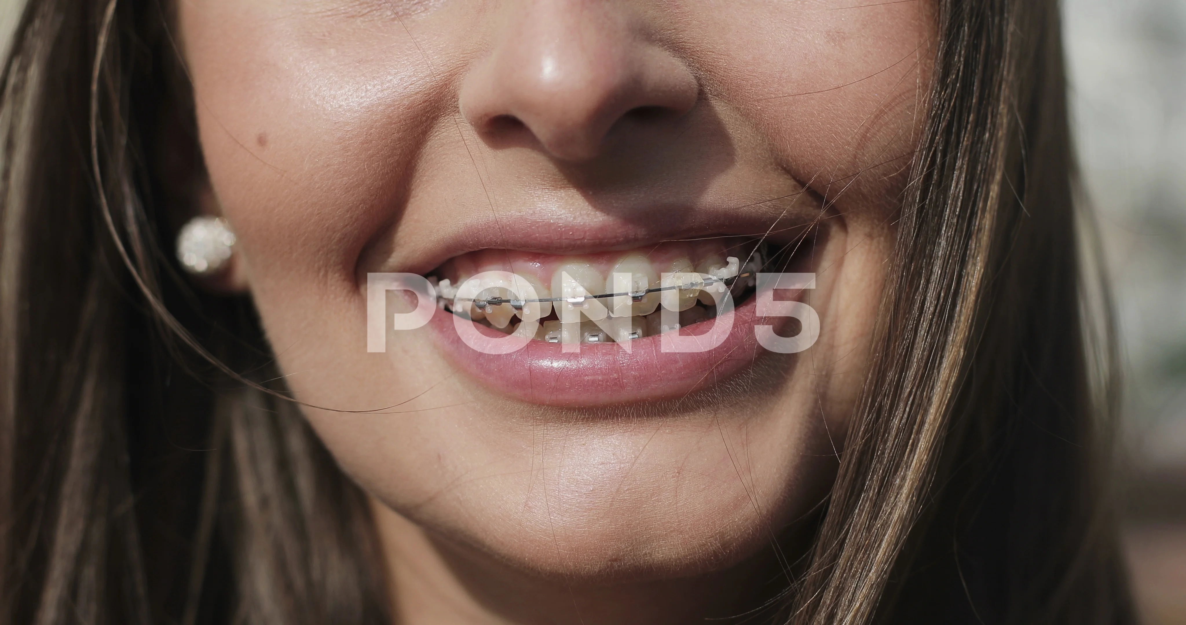 Close up young girl mouth with braces on teeth