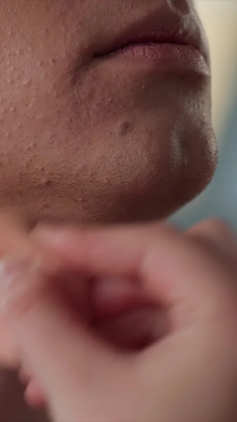 Close up of young man face and neck receiving skincare application with visible Stock Footage 343086931