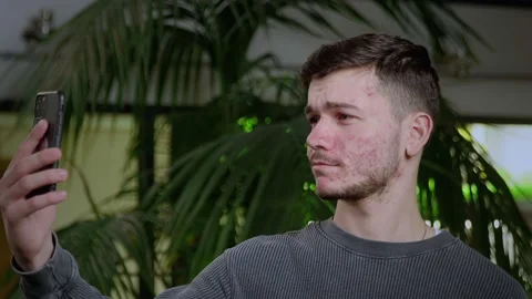 A close-up of a young man with problematic skin taking a selfie on his Stock Footage 195024196