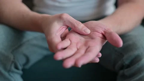 Close-up of a young man showing dry wrinkled skin on his hands and palms Stockbeeldmateriaal 337111173