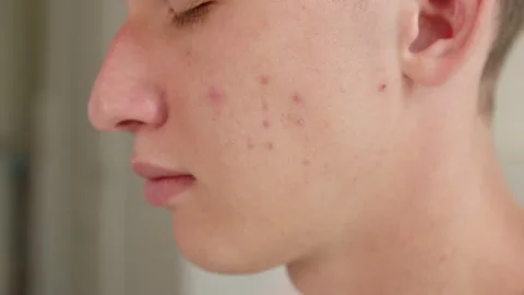 Close-up of a young mans face with acne breakouts, skin texture blemishes, .. Stock-Footage 339570647