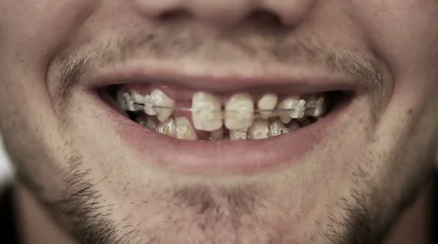 Close up of young man's face when a man smiling visible braces on teeth. Stock Footage 42968568