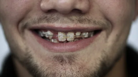 Close up of young man's face when a man smiling visible braces on teeth. Stock Footage 42969026