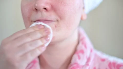 Close up of young woman cleaning problematic skin on her face UHD Stock Footage 151995522