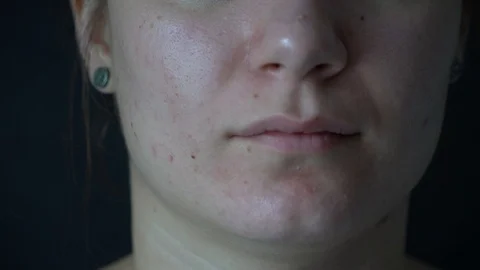 Close-up of a young woman's face. Problem skin with enlarged pores, acne. Vidéo 112377756