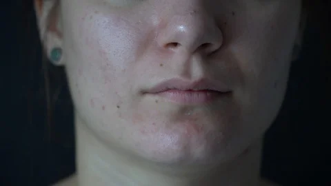 Close-up of a young woman's face. Problem skin with enlarged pores, acne. Vidéo 112377832