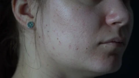 Close-up of a young woman's face. Problem skin with enlarged pores, acne. Vidéo 112377840