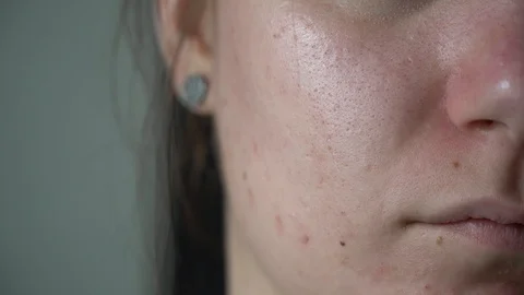 Close-up of a young woman's face. Problem skin with enlarged pores, acne. Vidéo 112378307