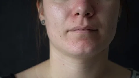 Close-up of a young woman's face. Problem skin with enlarged pores, acne. Vidéo 112378446