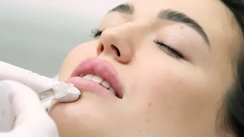 Close-up of a young woman's face undergoing lip augmentation procedure 動画素材 267753379