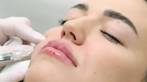 Close-up of a young woman's face undergoing lip augmentation procedure 動画素材 267753959