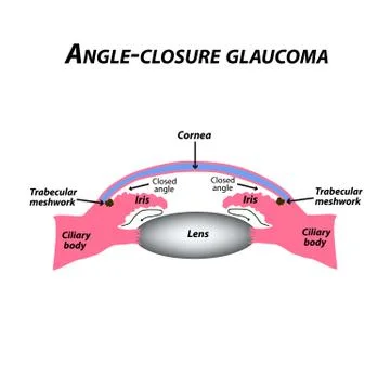 Closed angle glaucoma. A common type of glaucoma. The anatomical structure of Stock Illustration