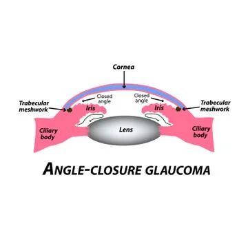 Closed angle glaucoma. A common type of glaucoma. The anatomical structure of Illustrazione stock