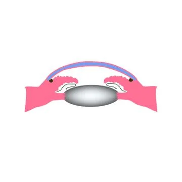 Closed angle glaucoma. A common type of glaucoma. The anatomical structure of Stock Illustration