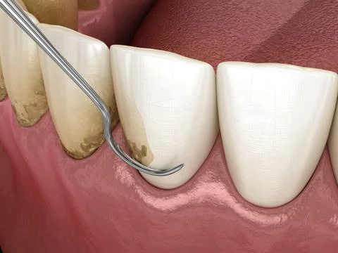 Closed curettage: Scaling and root planing (conventional periodontal therapy) Stock Illustration