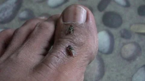 Closed up flies on the toe with sore skin Video stock 201128634