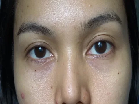 Closeup Asian Face with Pimples on the Cheeks and No Makeup Stock Footage 241634964