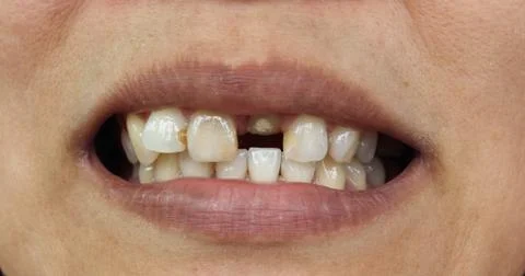 Closeup of bad teeth Stock Photos