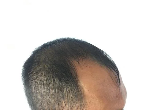 Closeup the beside of head lose hair of asian man. Glabrous as V shape. Stock Photos