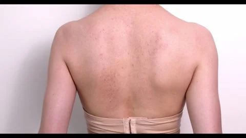 Closeup Bruises, Broken Capillaries After Cupping, Anti Cellulite Massage Stock Footage 276915533