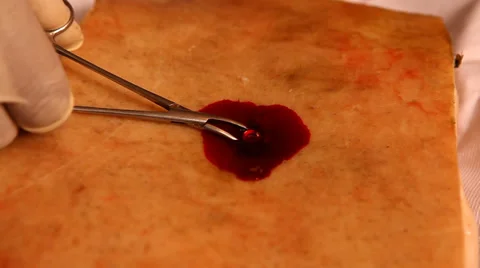 Closeup of Bullet wound operation Stock Footage 37904402