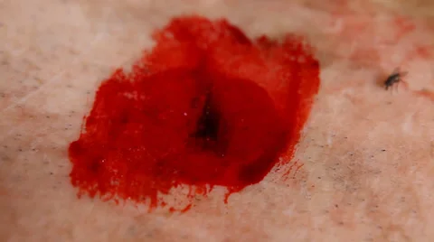 Closeup of Bullet wound operation Stock Footage 37904420