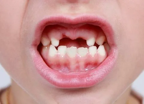Closeup of child's month with missing teeth Stock Photos