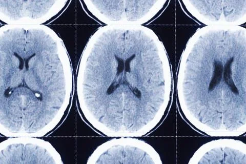 Closeup of computerized tomography of brain, xray film for doctor examination. 写真素材