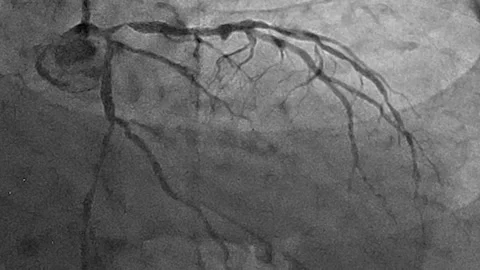 Closeup Of Coronary Angiogram X-Ray Of A Beating Heart, Veins And Stock Footage 152105797