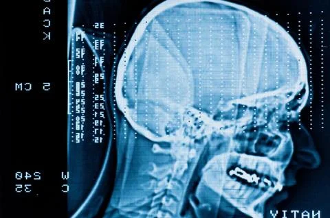 Closeup of a CT scan with brain and skull on it Stock Photos
