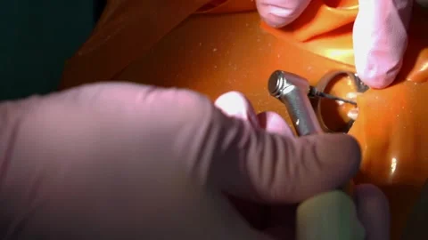 Closeup dental drill working on tooth during procedure Stock Footage 311674487