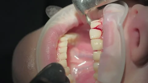 Closeup of a dental professional using an electrosurgical unit for gum reshaping Stock Footage 339274208