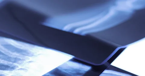 Closeup of different x-ray images on the table Stock Footage 233336224