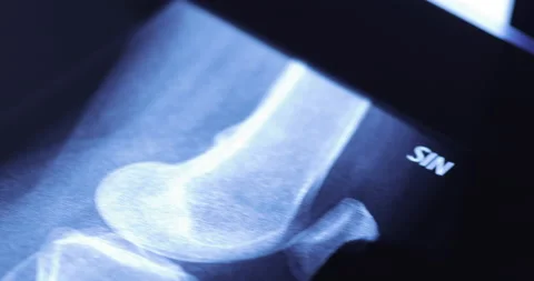 Closeup of different x-ray images on the table Stock-Footage 233336762