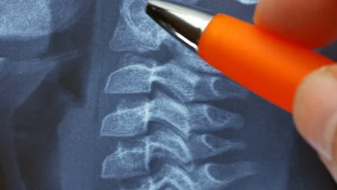 Closeup doctor examining and explaining x-ray image of a cervical vertebral colu Stock Footage 123043596