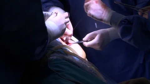 Closeup Of Doctors Working In Abdominal Incision 026a Stock Footage 124169859