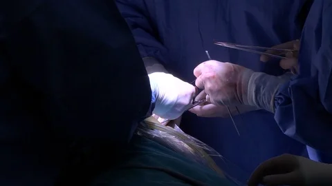 Closeup Of Doctors Working In Abdominal Incision 026b Stock Footage 124169884