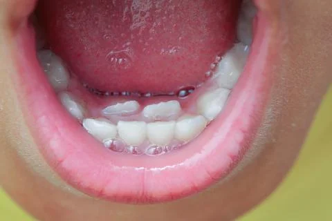Closeup of double row teeth 스톡 사진