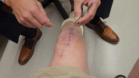Closeup-Dr.removing stitches from knee Video stock 263614025