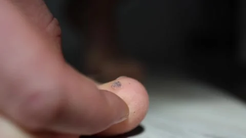 Closeup of fingers holding a toe with a dry crusty wart under harsh lighting det Stock Footage 312979290