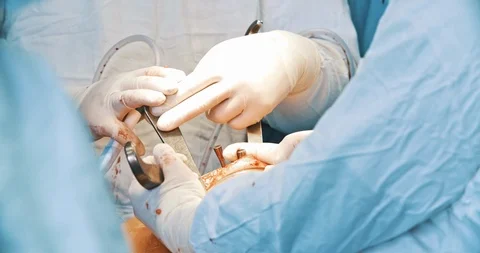 Closeup frame of surgical operation on knee. Medicine, surgery, health care Stock Footage 121103921