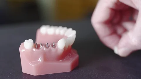 Closeup of hand demonstrating how dental implants are used Stock Footage 113749580