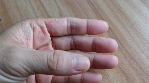 Closeup Hands with Atopic Dermatitis Eczema Stock Footage 240710876