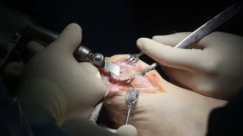 Closeup of the hands of the surgeon cut the tumor on the patient's bone saw Stock Footage 73137667
