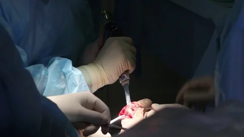 Closeup of hands of a surgeon.a hammer and chisel to cut out a tumor on a leg bo Stockbeeldmateriaal 73138244