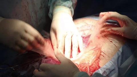 Closeup of hands of a surgeon removing a hernia patient Video stock 72931629