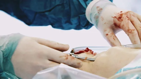 Closeup hands team of doctors and surgeons processing real surgical knee Stock-Footage 229907513